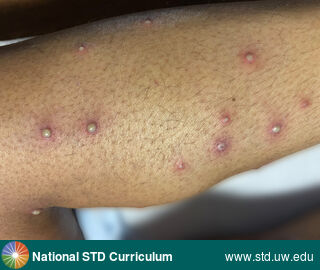 Diagnosis: Mpox,  Clinical Signs: Pustule / Pustules,  Locations: Calf, Dark skin tone, Symptoms: N/A,  Image Type: Photo