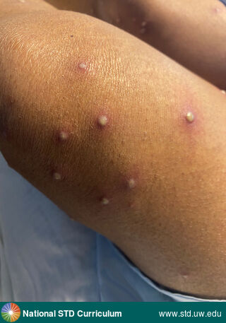 Diagnosis: Mpox,  Clinical Signs: Pustule / Pustules,  Locations: Dark skin tone, Thigh, Symptoms: N/A,  Image Type: Photo