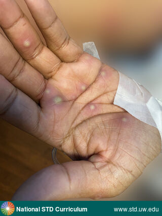 Diagnosis: Mpox,  Clinical Signs: Pustule / Pustules, Vesicle / Vesicles,  Locations: Dark skin tone, Hand (Left), Symptoms: Painful,  Image Type: Photo