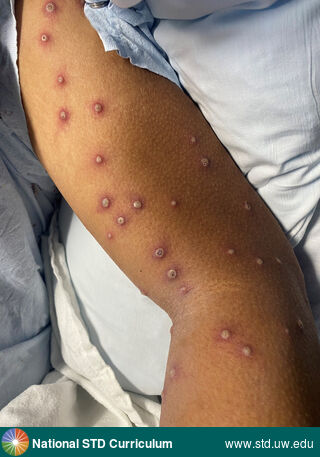 Diagnosis: Mpox,  Clinical Signs: Pustule / Pustules,  Locations: Arm (Left), Dark skin tone, Symptoms: Painful,  Image Type: Photo