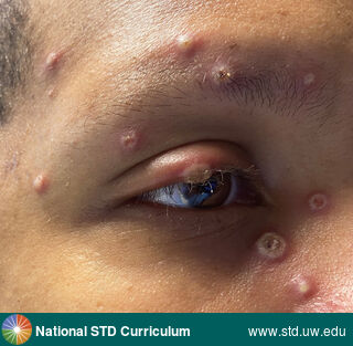 Diagnosis: Mpox,  Clinical Signs: Pustule / Pustules, Vesicle / Vesicles,  Locations: Dark skin tone, Eye, Face, Symptoms: Painful,  Image Type: Photo
