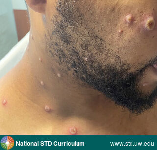 Diagnosis: Mpox,  Clinical Signs: Pustule / Pustules, Vesicle / Vesicles,  Locations: Dark skin tone, Face, Neck, Trunk/Torso, Symptoms: Painful,  Image Type: Photo