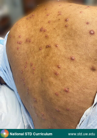 Diagnosis: Mpox,  Clinical Signs: Pustule / Pustules,  Locations: Back, Dark skin tone, Symptoms: N/A,  Image Type: Photo