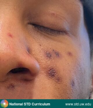 Diagnosis: Mpox,  Clinical Signs: Scab,  Locations: Dark skin tone, Face, Symptoms: Non-Painful, Painful,  Image Type: Photo