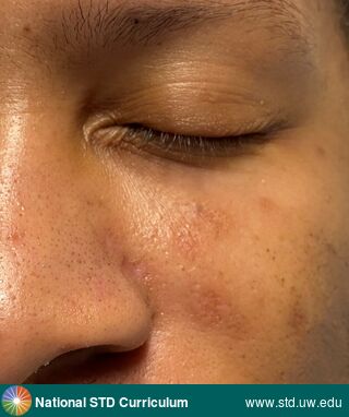 Diagnosis: Mpox,  Clinical Signs: Healed lesions,  Locations: Dark skin tone, Face, Symptoms: Non-Painful,  Image Type: Photo