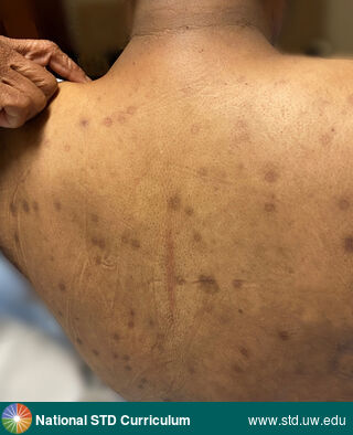Diagnosis: Mpox,  Clinical Signs: Healed lesions,  Locations: Back, Dark skin tone, Symptoms: N/A,  Image Type: Photo