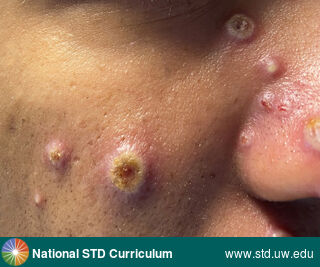 Diagnosis: Mpox,  Clinical Signs: Pustule / Pustules, Vesicle / Vesicles,  Locations: Dark skin tone, Face, Symptoms: Painful,  Image Type: Photo