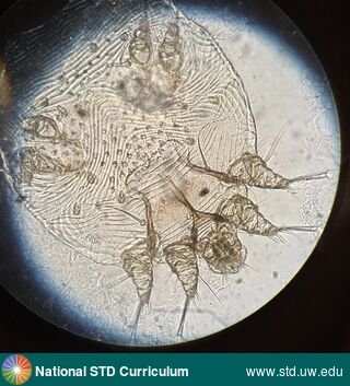 Diagnosis: Scabies,  Clinical Signs: N/A,  Locations: Microscope, Symptoms: N/A,  Image Type: Photo