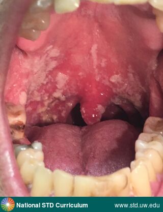 Diagnosis: Candidiasis-Oral,  Clinical Signs: Patch/Patches, Plaque,  Locations: Pharynx, Symptoms: N/A,  Image Type: Photo