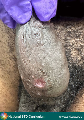 Diagnosis: Mpox,  Clinical Signs: Ulcer / Ulcers,  Locations: Dark skin tone, Penis, Symptoms: N/A,  Image Type: Photo