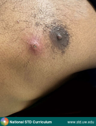 Diagnosis: Mpox,  Clinical Signs: Ulcer / Ulcers, Umbilicated, Vesicle / Vesicles,  Locations: Chest, Dark skin tone, Symptoms: Itch, Painful,  Image Type: Photo