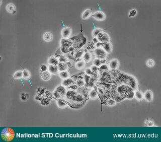 Diagnosis: Trichomoniasis,  Clinical Signs: N/A,  Locations: Microscope-Wet Mount, Symptoms: N/A,  Image Type: Photo