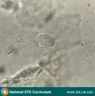Diagnosis: Trichomoniasis,  Clinical Signs: N/A,  Locations: Microscope-Wet Mount, Symptoms: N/A,  Image Type: Photo