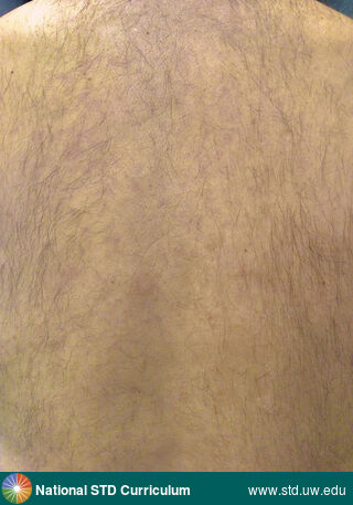 Diagnosis: Tinea versicolor,  Clinical Signs: Hyperpigmentation, Macule / Macules,  Locations: Back, Symptoms: Itch, Non-Painful, Rash,  Image Type: Photo