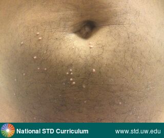 Diagnosis: Molluscum,  Clinical Signs: Papule / Papules, Umbilicated,  Locations: Abdomen, Suprapubic (Hypogastrium), Symptoms: Non-Itchy, Non-Painful,  Image Type: Photo