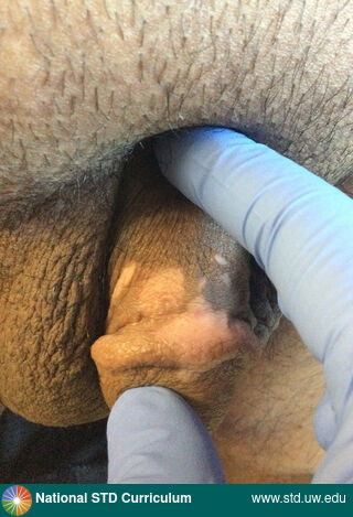 Diagnosis: Vitiligo,  Clinical Signs: Hypopigmentation, Macule / Macules,  Locations: Dark skin tone, Penis, Symptoms: Non-Itchy, Non-Painful,  Image Type: Photo