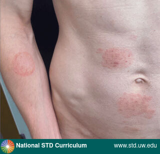 Diagnosis: Trichophyton mentagrophytes genotype VII (TMVII), Clinical Signs: Annular, Erythema, Plaque, Rash, Scale, Locations: Abdomen, Arm (Right), Light skin tone, Suprapubic (Hypogastrium), Symptoms: Rash, Image Type: Photo