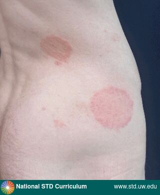 Diagnosis: Trichophyton mentagrophytes genotype VII (TMVII), Clinical Signs: Annular, Erythema, Plaque, Scale, Locations: Back, Buttock, Light skin tone, Symptoms: N/A, Image Type: Photo