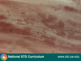 Diagnosis: Gonorrhea, Clinical Signs: Discharge / Anal, Locations: Anal / Intra-anal, Microscope-Gram Stain, Rectal, Symptoms: Discharge, Painful, Image Type: Photo