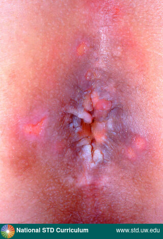 Diagnosis: Herpes-Genital,  Clinical Signs: Ulcer / Ulcers,  Locations: Anal / Perianal, Light skin tone, Symptoms: Painful,  Image Type: Photo
