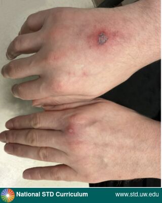 Diagnosis: Gonorrhea,  Clinical Signs: Pustule / Pustules, Scab, Ulcer / Ulcers,  Locations: Arm (Left), Arm (Right), Light skin tone, Symptoms: N/A,  Image Type: Photo