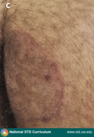 Diagnosis: Trichophyton indotineae, Clinical Signs: Annular, Hyperpigmentation, Scale, Locations: Buttock, Light skin tone, Symptoms: Rash, Image Type: Photo