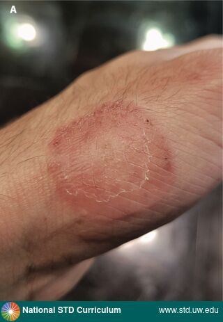 Diagnosis: Trichophyton indotineae, Clinical Signs: Annular, Erythema, Scale, Locations: Hand (Left), Light skin tone, Symptoms: N/A, Image Type: Photo
