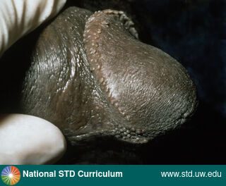 Diagnosis: Pearly penile papules, Clinical Signs: Papule / Papules, Locations: Dark skin tone, Penis, Symptoms: N/A, Image Type: Photo