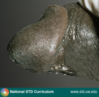 Diagnosis: Tyson's glands, Clinical Signs: Papule / Papules, Locations: Dark skin tone, Penis, Symptoms: N/A, Image Type: Photo