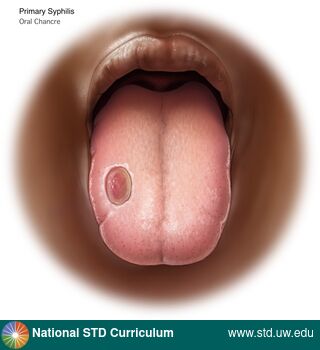 Diagnosis: Syphilis - Primary, Clinical Signs: Ulcer / Ulcers, Locations: Dark skin tone, Tongue, Symptoms: Non-Painful, Image Type: Illustration