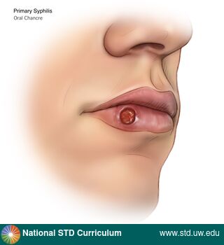Diagnosis: Syphilis - Primary, Clinical Signs: Ulcer / Ulcers, Locations: Light skin tone, Lips, Symptoms: Non-Painful, Image Type: Illustration
