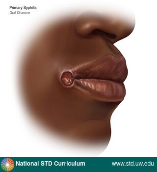 Diagnosis: Syphilis - Primary, Clinical Signs: Ulcer / Ulcers, Locations: Dark skin tone, Lips, Symptoms: Non-Painful, Image Type: Illustration