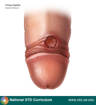 Diagnosis: Syphilis - Primary, Clinical Signs: Ulcer / Ulcers, Locations: Light skin tone, Penis, Symptoms: Non-Painful, Image Type: Illustration