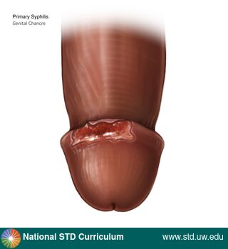 Diagnosis: Syphilis - Primary, Clinical Signs: Ulcer / Ulcers, Locations: Dark skin tone, Penis, Symptoms: Non-Painful, Image Type: Illustration