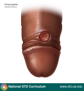 Diagnosis: Syphilis - Primary, Clinical Signs: Ulcer / Ulcers, Locations: Dark skin tone, Penis, Symptoms: Non-Painful, Image Type: Illustration