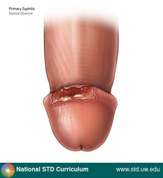 Diagnosis: Syphilis - Primary, Clinical Signs: Ulcer / Ulcers, Locations: Light skin tone, Penis, Symptoms: Non-Painful, Image Type: Illustration