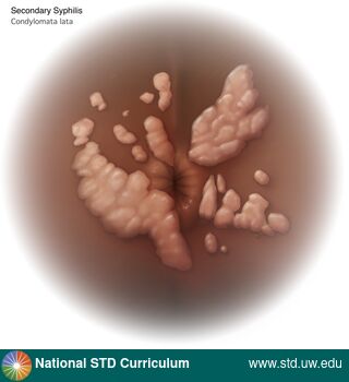 Diagnosis: Syphilis - Secondary, Clinical Signs: Papule / Papules, Verrucous, Locations: Anal / Perianal, Dark skin tone, Symptoms: Non-Painful, Image Type: Illustration