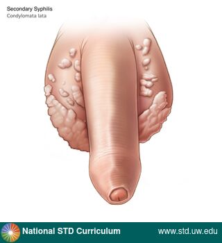 Diagnosis: Syphilis - Secondary, Clinical Signs: Papule / Papules, Verrucous, Locations: Light skin tone, Scrotum, Symptoms: Non-Painful, Image Type: Illustration