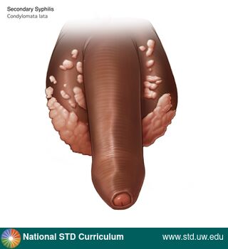 Diagnosis: Syphilis - Secondary, Clinical Signs: Papule / Papules, Verrucous, Locations: Dark skin tone, Scrotum, Symptoms: Non-Painful, Image Type: Illustration
