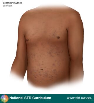 Diagnosis: Syphilis - Secondary, Clinical Signs: Macule / Macules, Papule / Papules, Scale, Locations: Abdomen, Dark skin tone, Trunk/Torso, Symptoms: Non-Painful, Rash, Image Type: Illustration