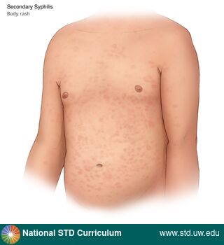 Diagnosis: Syphilis - Secondary, Clinical Signs: Macule / Macules, Locations: Abdomen, Light skin tone, Trunk/Torso, Symptoms: Non-Painful, Rash, Image Type: Illustration