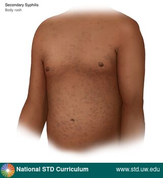 Diagnosis: Syphilis - Secondary, Clinical Signs: Macule / Macules, Locations: Abdomen, Dark skin tone, Trunk/Torso, Symptoms: Non-Painful, Rash, Image Type: Illustration