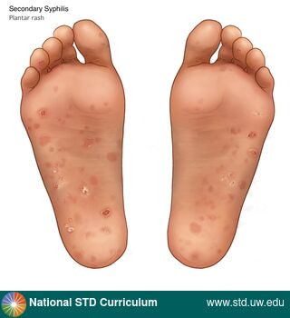 Diagnosis: Syphilis - Secondary, Clinical Signs: Macule / Macules, Papule / Papules, Scale, Locations: Feet/Soles, Light skin tone, Symptoms: Non-Painful, Rash, Image Type: Illustration