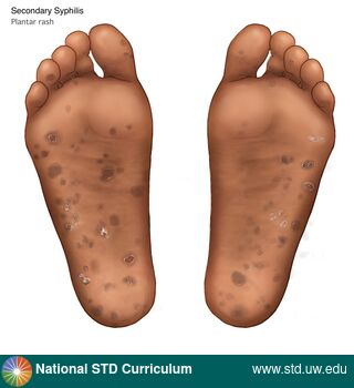 Diagnosis: Syphilis - Secondary, Clinical Signs: Macule / Macules, Papule / Papules, Scale, Locations: Dark skin tone, Feet/Soles, Symptoms: Non-Painful, Rash, Image Type: Illustration