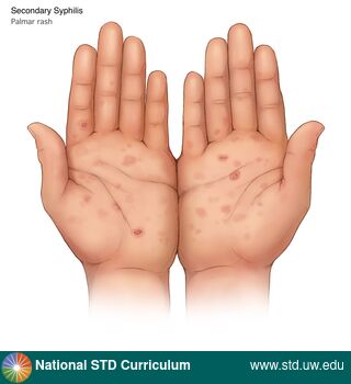 Diagnosis: Syphilis - Secondary, Clinical Signs: Macule / Macules, Papule / Papules, Scale, Locations: Hands, Light skin tone, Symptoms: Non-Painful, Rash, Image Type: Illustration