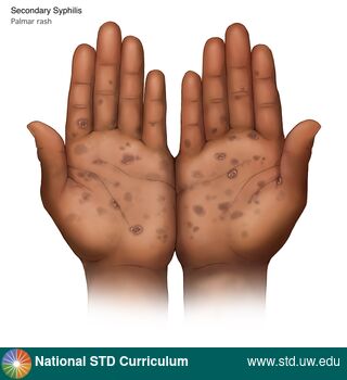 Diagnosis: Syphilis - Secondary, Clinical Signs: Macule / Macules, Papule / Papules, Scale, Locations: Dark skin tone, Hands, Symptoms: Non-Painful, Rash, Image Type: Illustration
