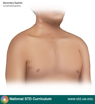 Diagnosis: Syphilis - Secondary, Clinical Signs: Adenopathy, Locations: Neck, Symptoms: Non-Painful, Image Type: Illustration