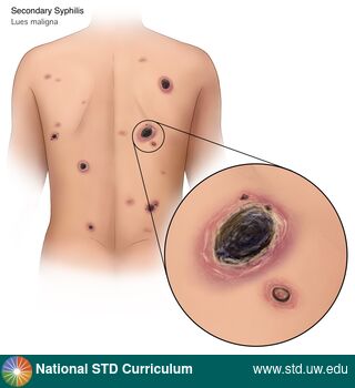 Diagnosis: Syphilis - Secondary, Clinical Signs: Scab, Ulcer / Ulcers, Locations: Back, Light skin tone, Symptoms: N/A, Image Type: Illustration