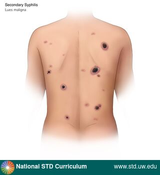 Diagnosis: Syphilis - Secondary, Clinical Signs: Scab, Ulcer / Ulcers, Locations: Back, Light skin tone, Symptoms: N/A, Image Type: Illustration