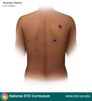Diagnosis: Syphilis - Secondary, Clinical Signs: Scab, Ulcer / Ulcers, Locations: Back, Dark skin tone, Symptoms: N/A, Image Type: Illustration